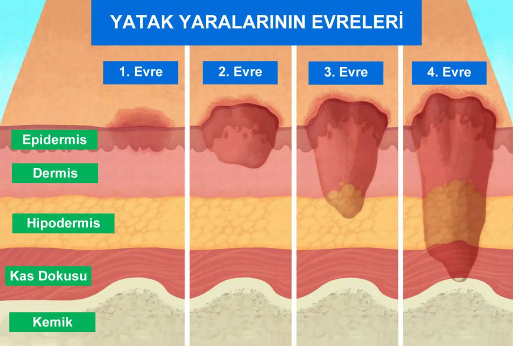 Yatak yaralarının evreleri, bası yaralarının aşamaları